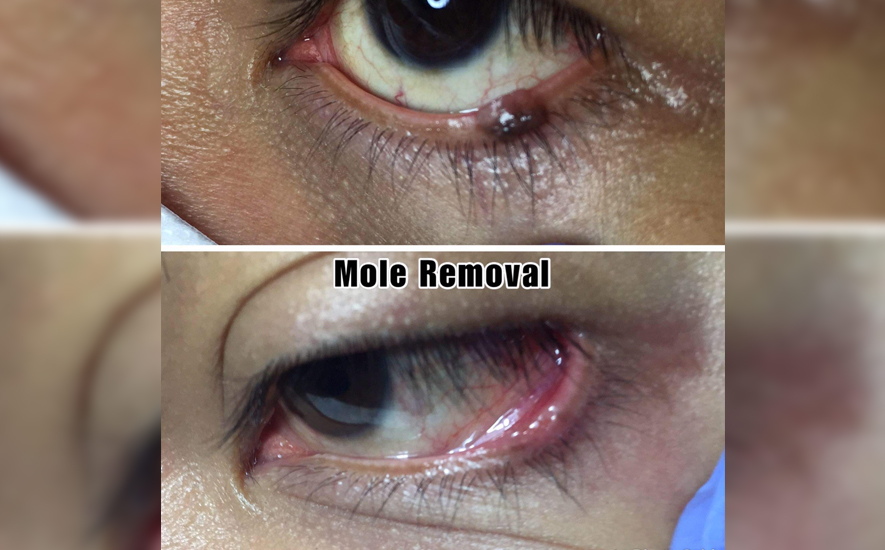 mole removal img